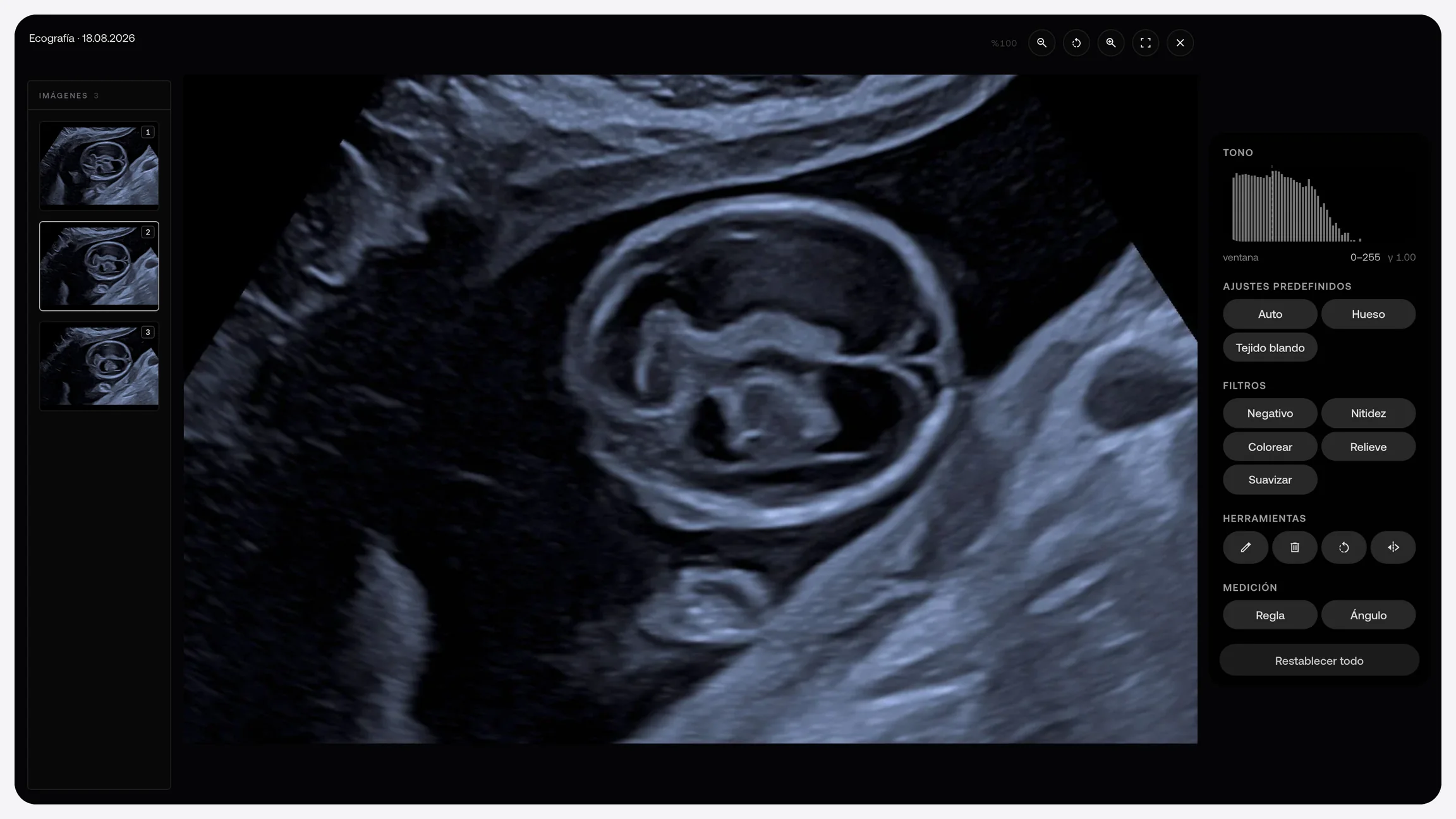 Ecografía fetal de ejemplo en el visor de MyKlinik